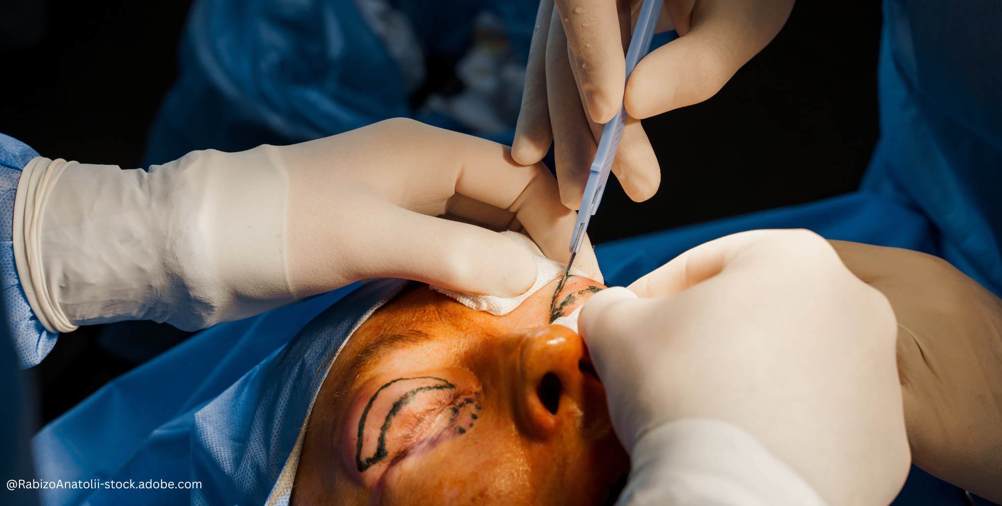 Was tun gegen Schlupflider? Korrektur beim Augenarzt