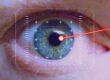 Augen wird von Laser behandelt