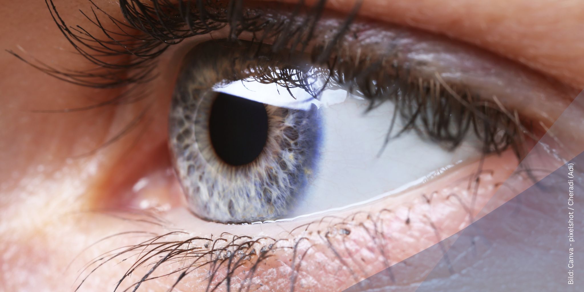 Nahaufnahme des Auges einer Frau zum Thema IPCL – die implantierbare Kontaktlinse als moderne Alternative zur Laserbehandlung in Mainz