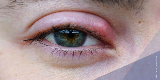 gerstenkorn-hordeolum-was-ist-das Nahaufnahme Auge mit Gerstenkorn