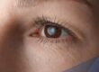Nahaufnahme augen einer Frau mit Linsentrübung zum Thema Premiumlinsen Grauer Star Kosten
